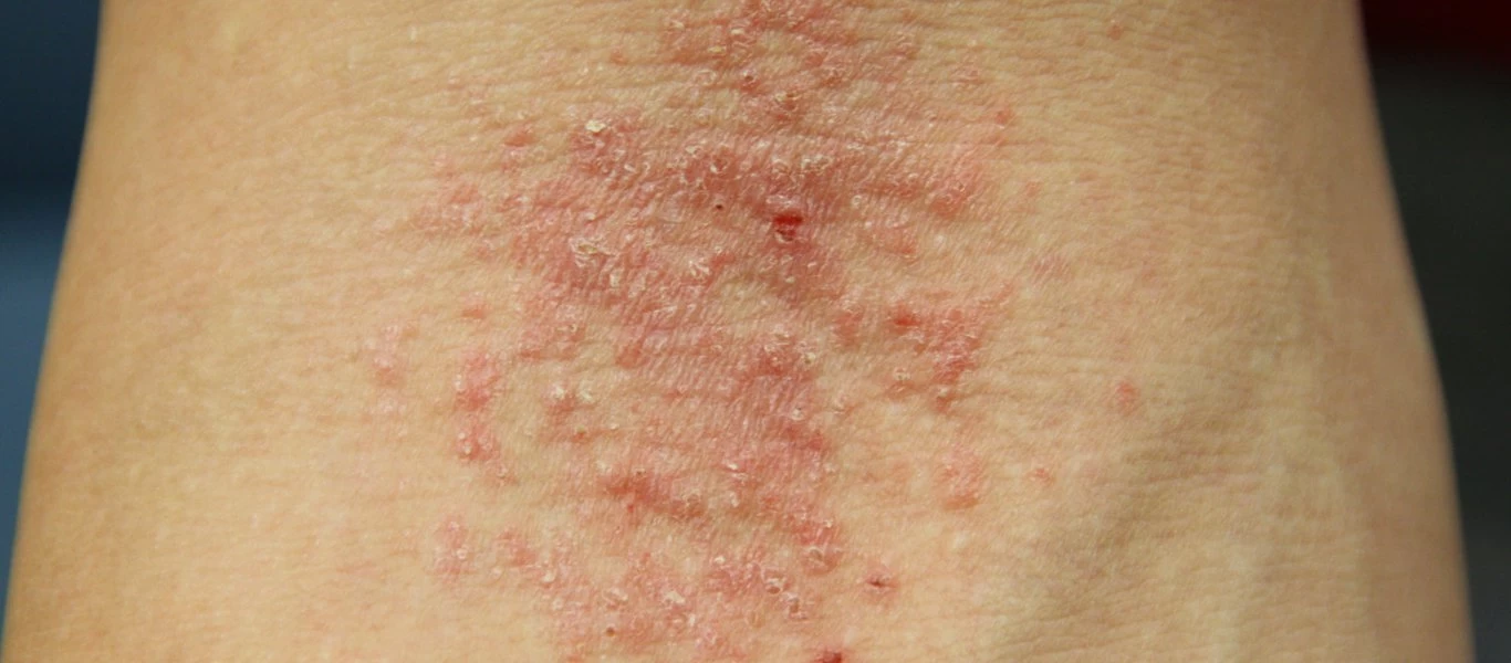 Ατοπική Δερματίτιδα: Από τι προκαλείται και πως αντιμετωπίζεται (βίντεο)